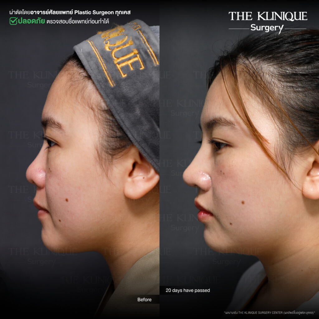 รีวิวเสริมจมูก Semi Open