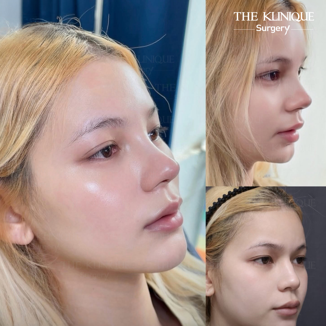 รีวิวเสริมจมูก Semi Open