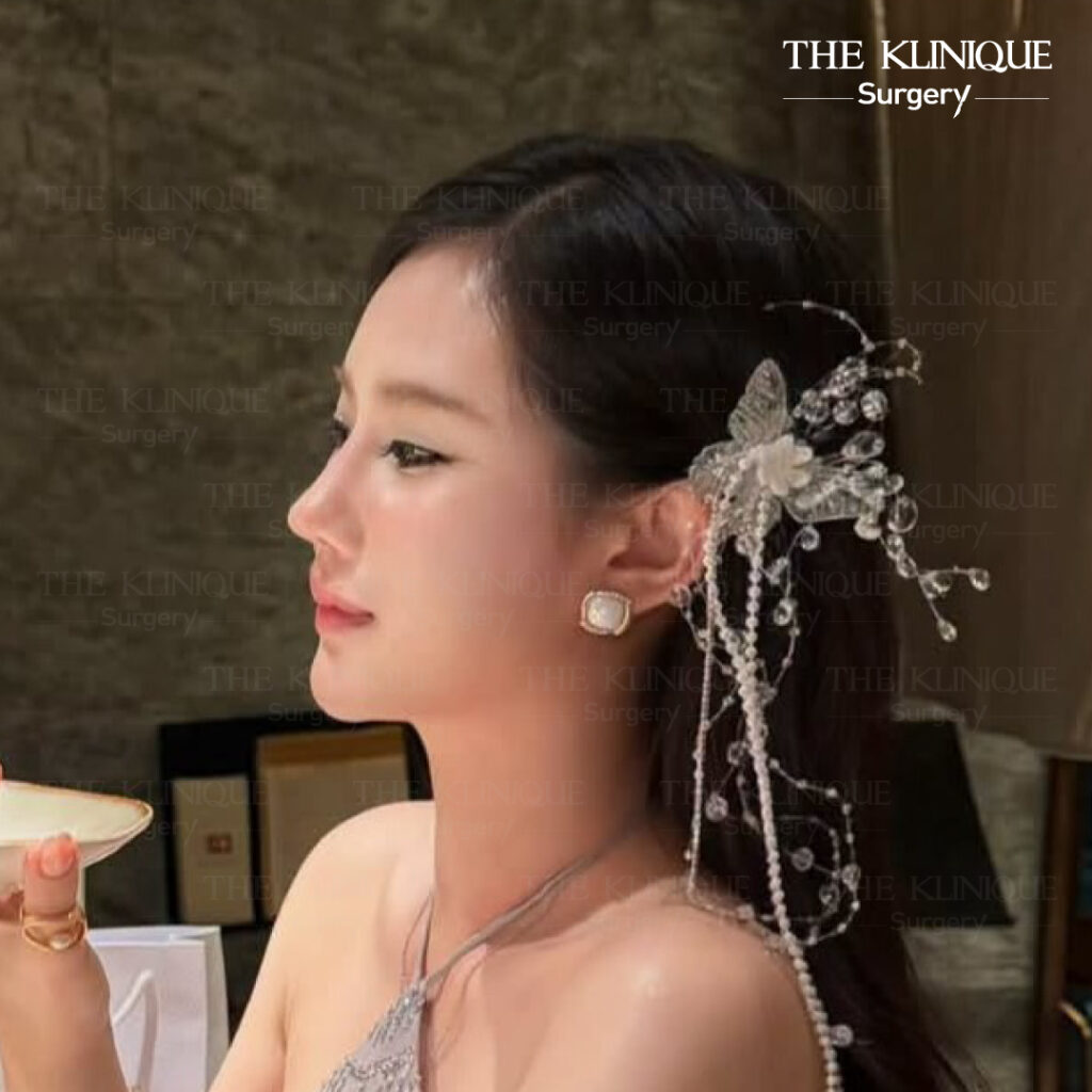 รีวิวเสริมจมูก Semi Open