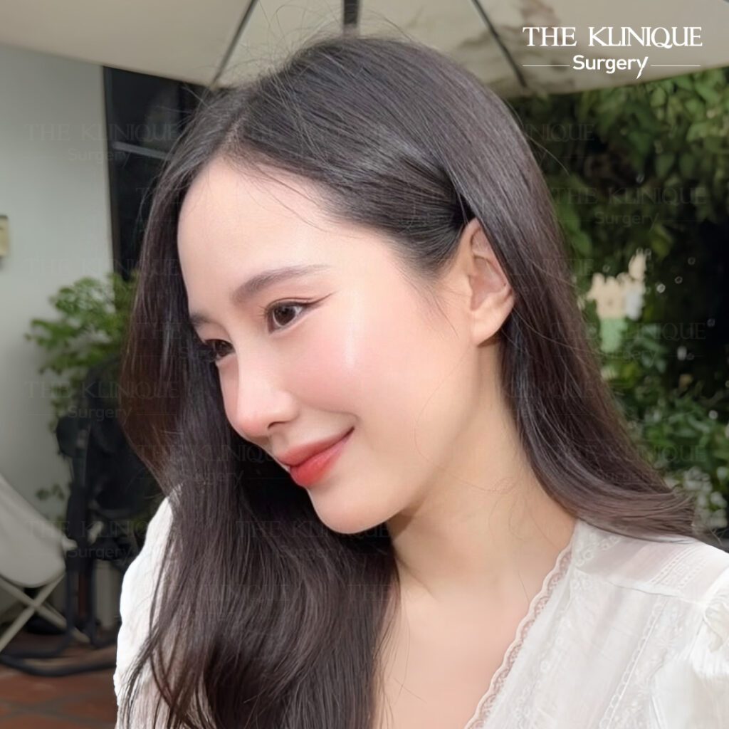 รีวิวเสริมจมูก Semi Open