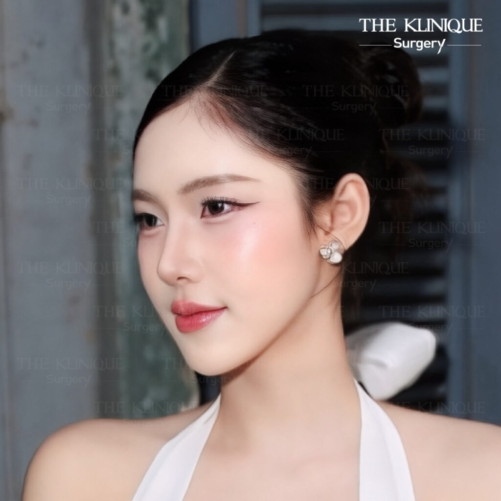 รีวิวเสริมจมูก Semi Open