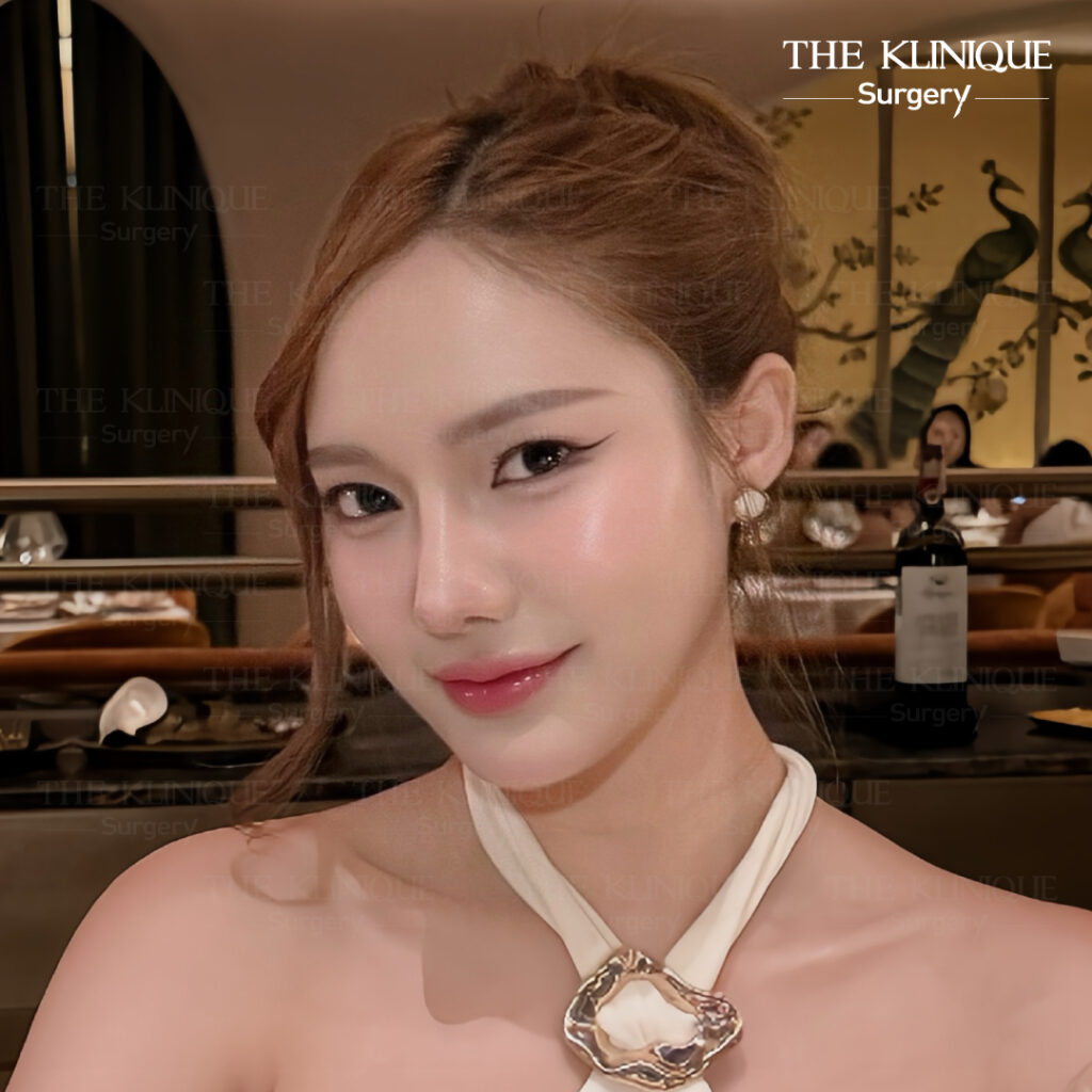 รีวิวเสริมจมูก Semi Open