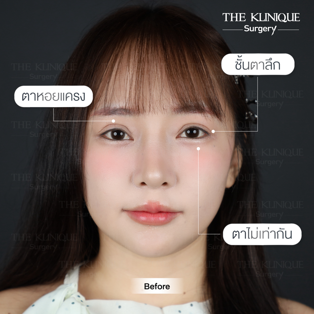 รีวิวแก้ตาสองชั้น-เอมมี่-สุนันทา-ฮารุกะจัง-หลังแก้ตา1ปี