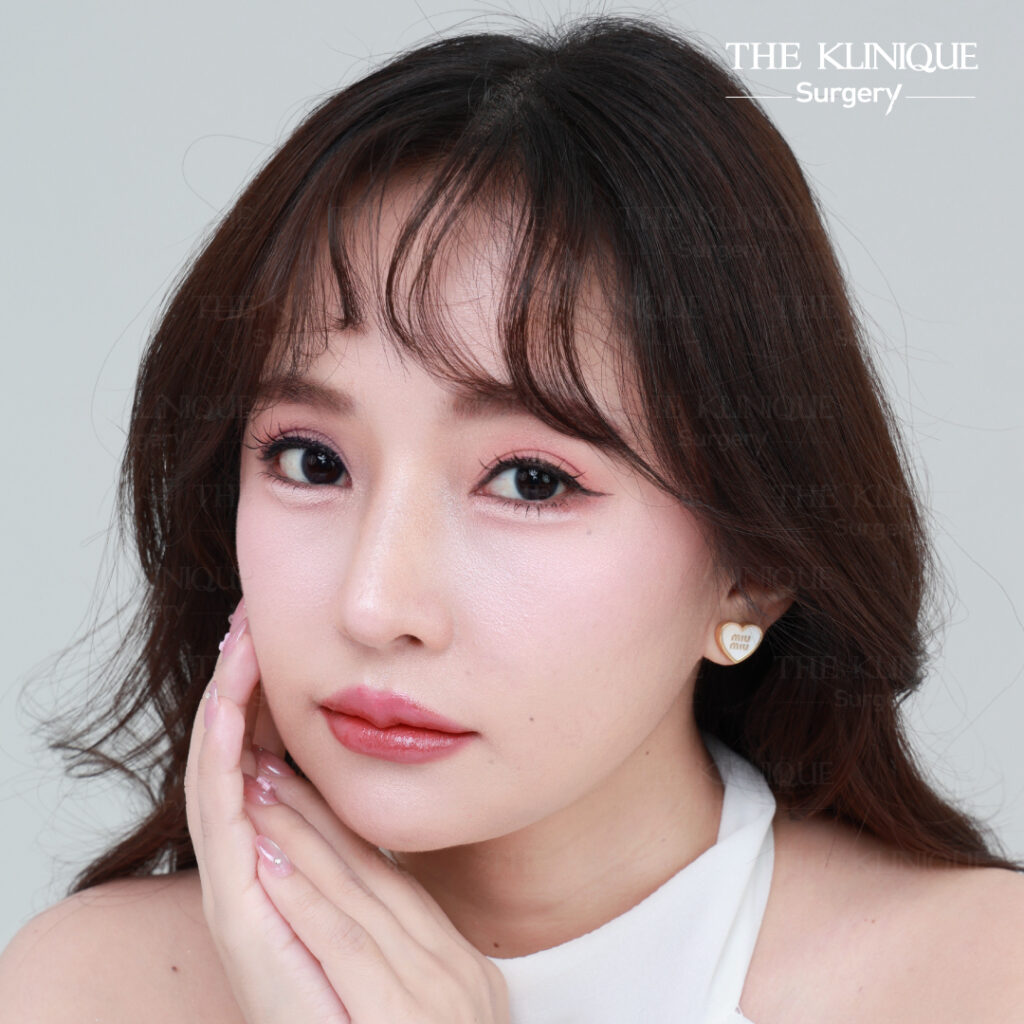 รีวิวแก้ตาสองชั้น-เอมมี่-สุนันทา-ฮารุกะจัง-หลังแก้ตา1ปี