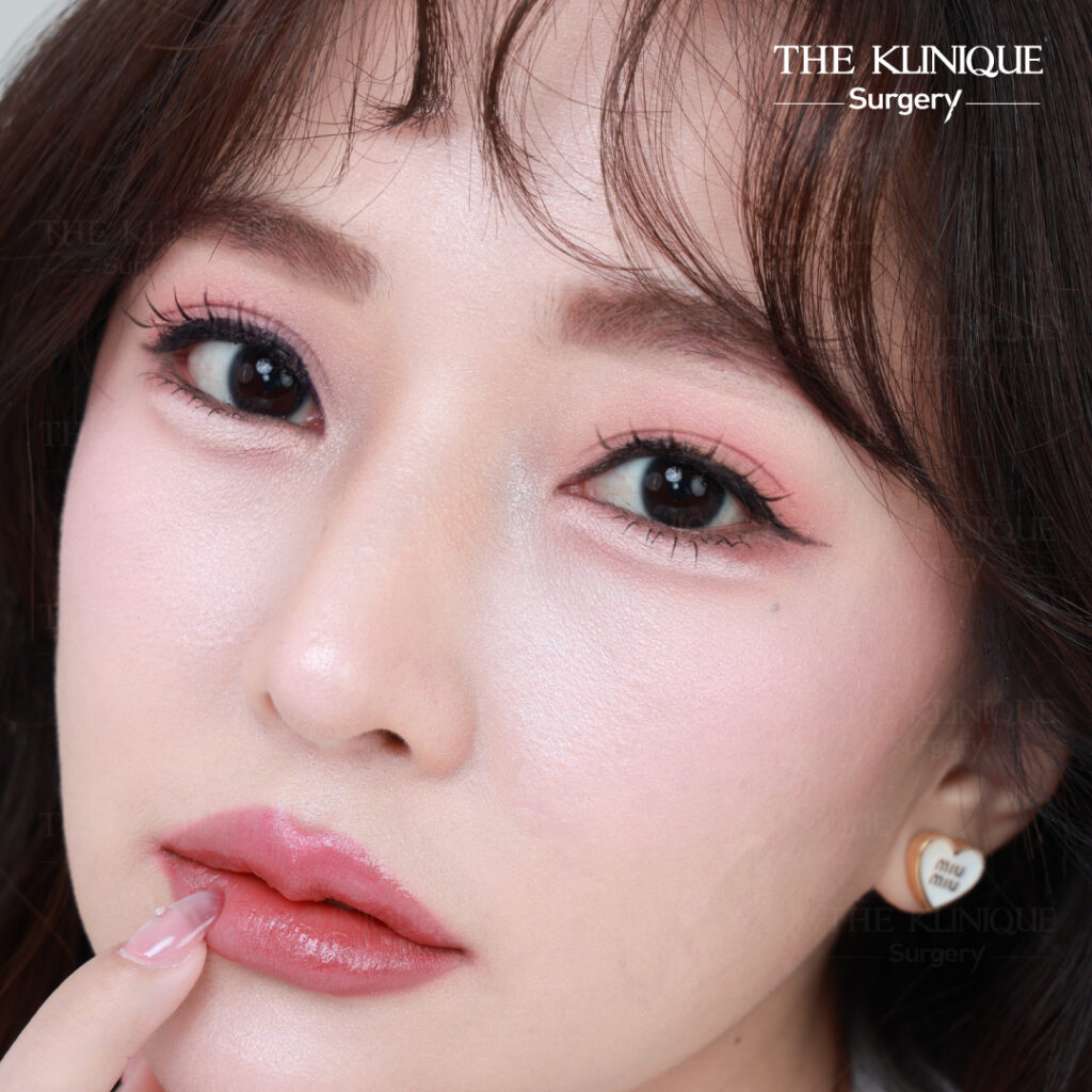 รีวิวแก้ตาสองชั้น-เอมมี่-สุนันทา-ฮารุกะจัง-หลังแก้ตา1ปี