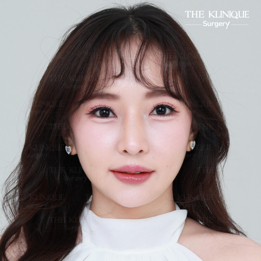 รีวิวแก้ตาสองชั้น-เอมมี่-สุนันทา-ฮารุกะจัง-หลังแก้ตา1ปี