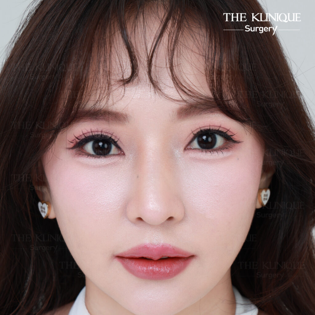รีวิวแก้ตาสองชั้น-เอมมี่-สุนันทา-ฮารุกะจัง-หลังแก้ตา1ปี