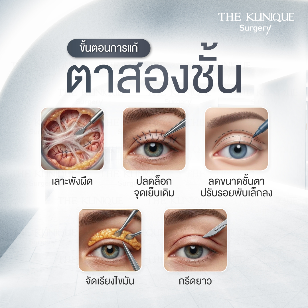 รีวิวแก้ตาสองชั้น-เอมมี่-สุนันทา-ฮารุกะจัง-หลังแก้ตา1ปี