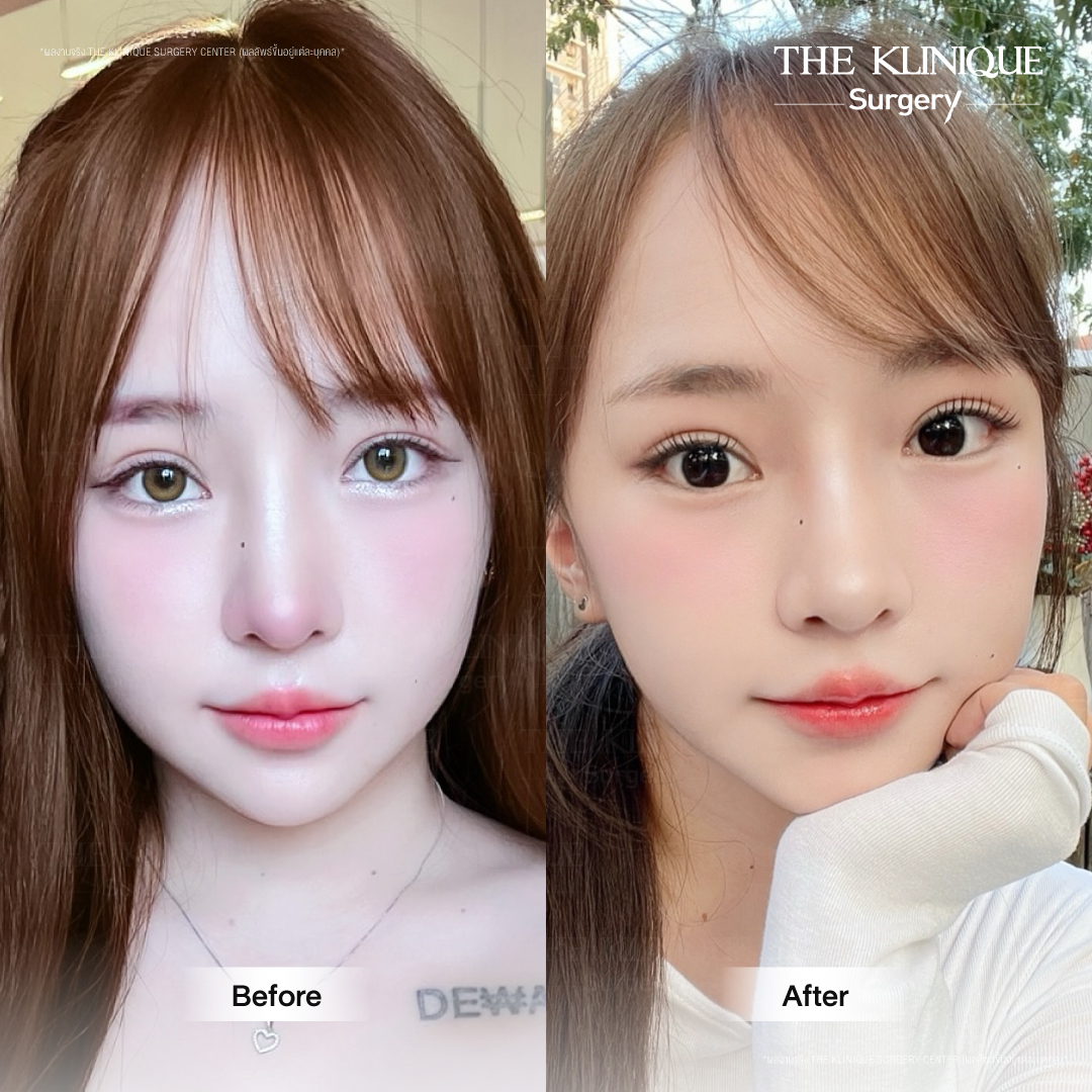รีวิวแก้ตาสองชั้น-เอมมี่-สุนันทา-ฮารุกะจัง-หลังแก้ตา1ปี