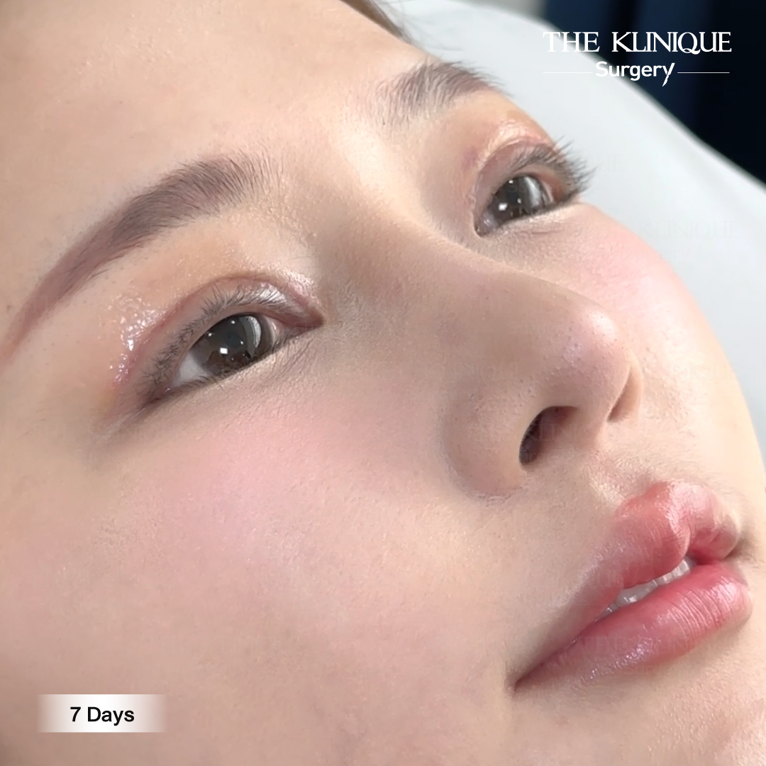 รีวิวแก้ตาสองชั้น-เอมมี่-สุนันทา-ฮารุกะจัง-หลังแก้ตา1ปี