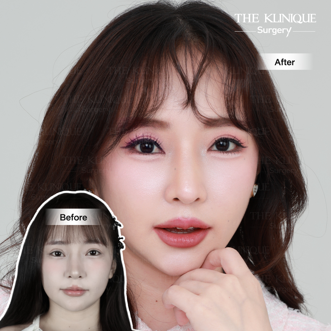 รีวิวแก้ตาสองชั้น-เอมมี่-สุนันทา-ฮารุกะจัง-หลังแก้ตา1ปี
