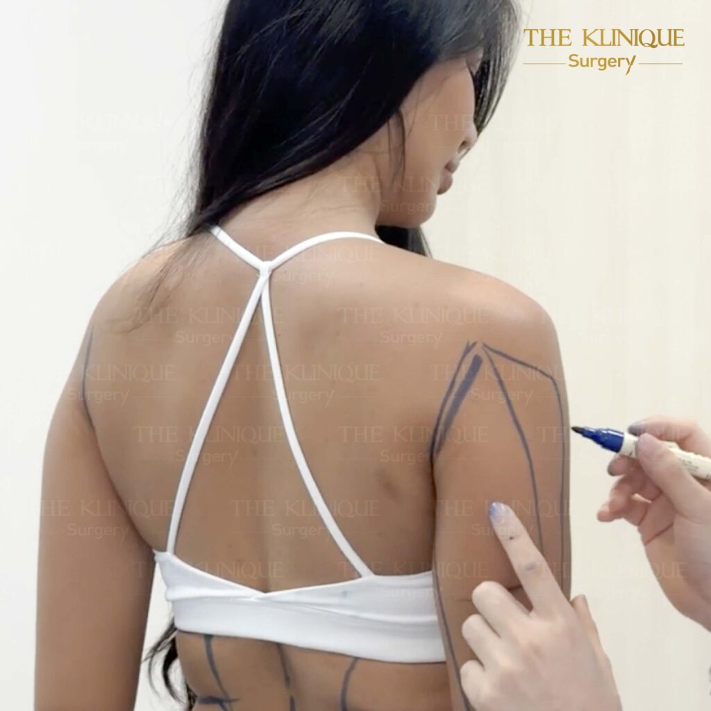 รีวิวดูดไขมันทั้งตัว Sexy Line