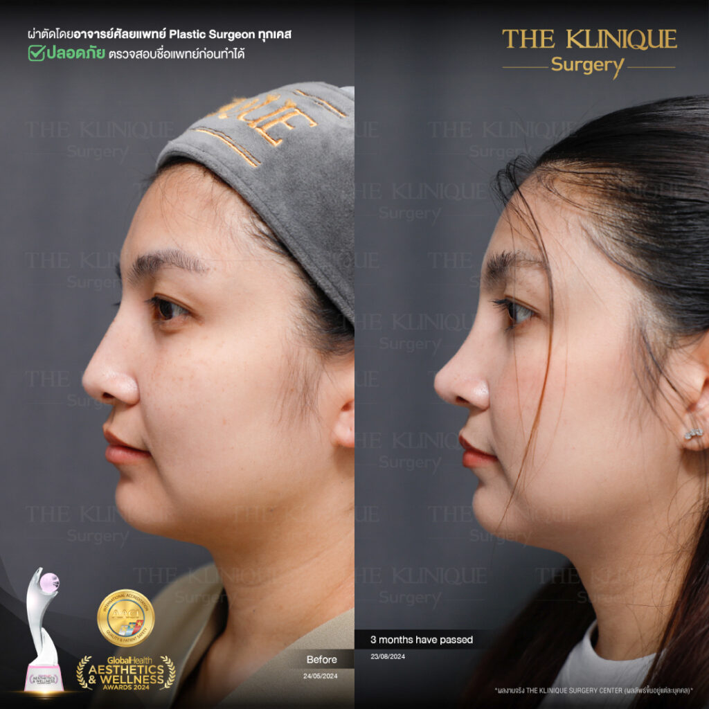 รีวิว เสริมจมูก Semi Open