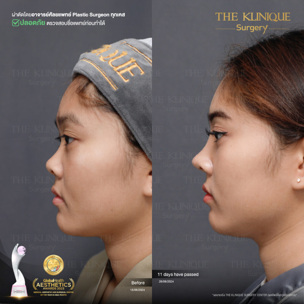 รีวิว เสริมจมูก Semi Open
