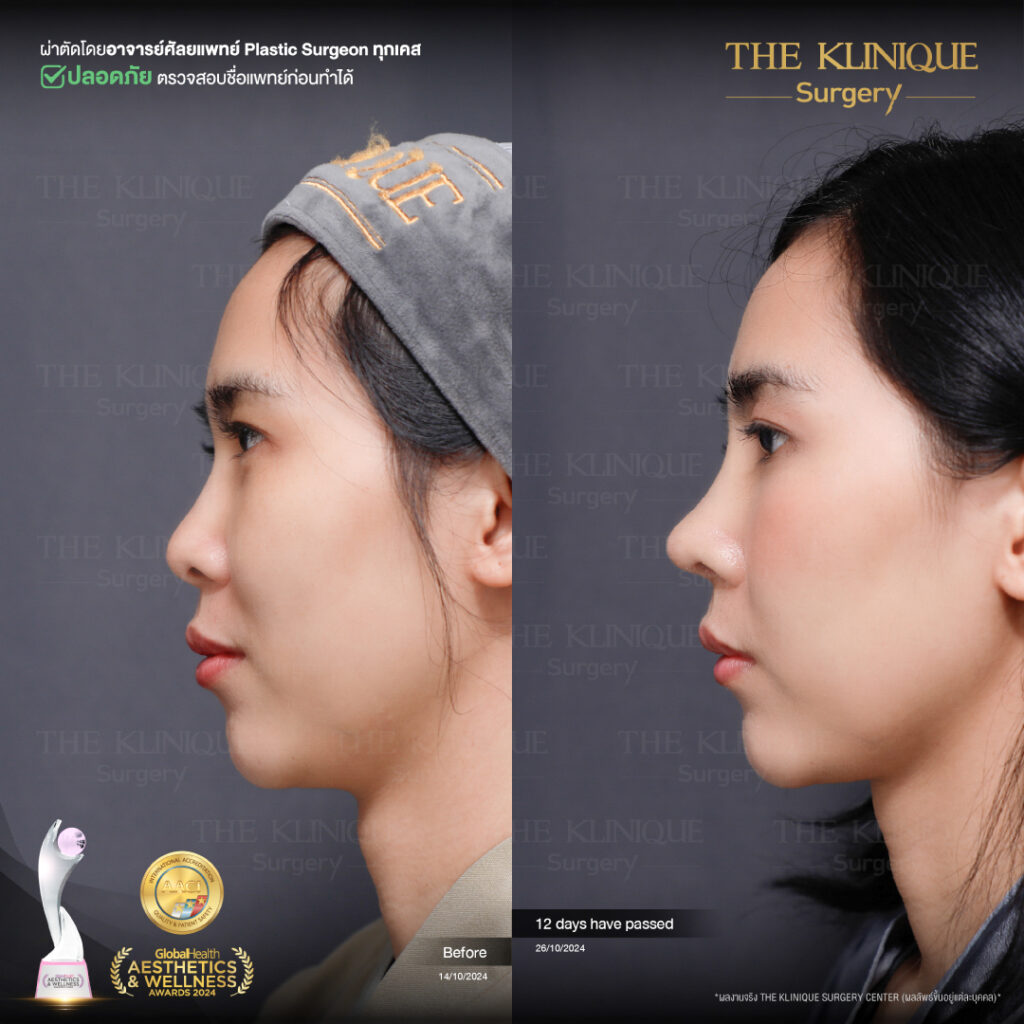 รีวิว เสริมจมูก Semi Open