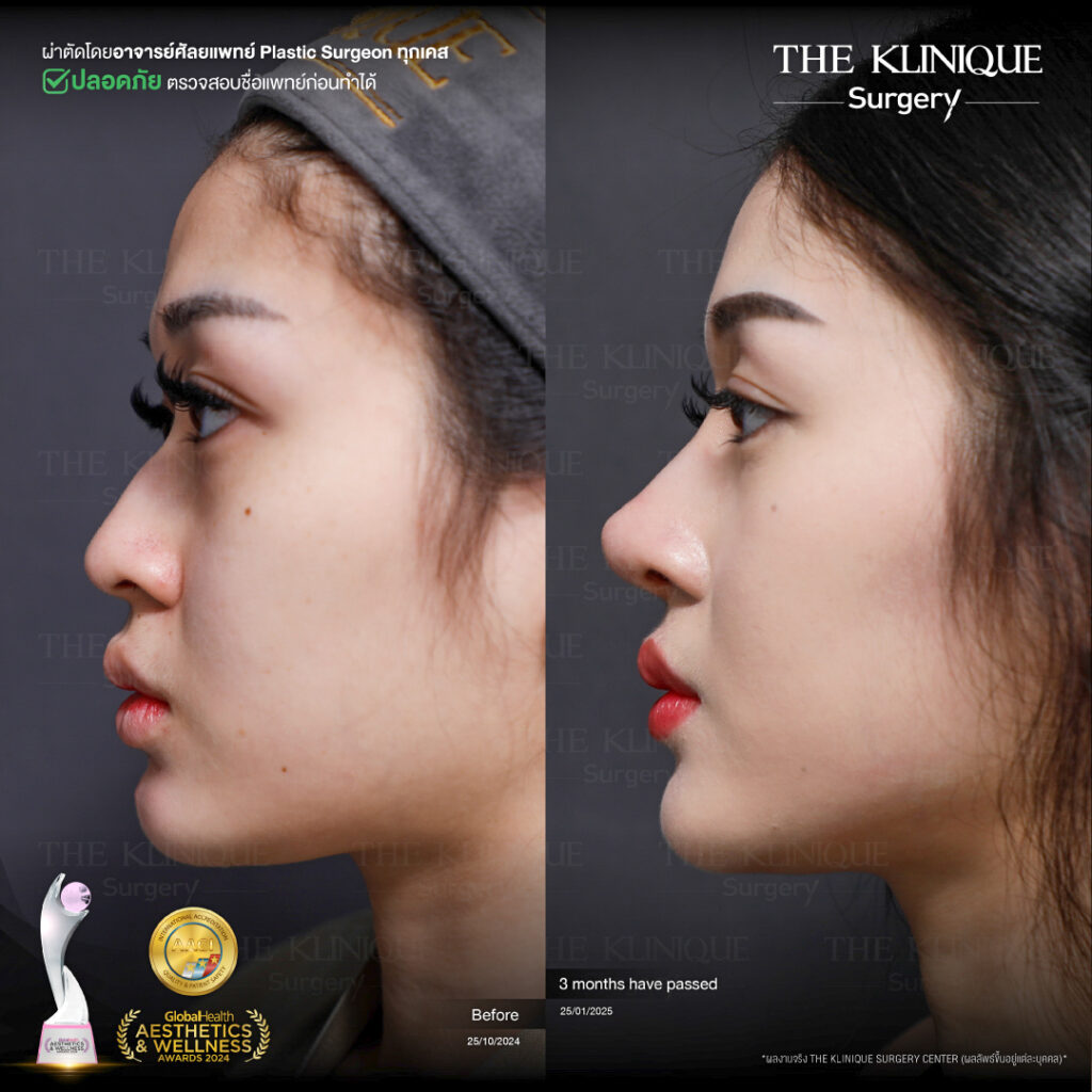 รีวิว เสริมจมูก Semi Open