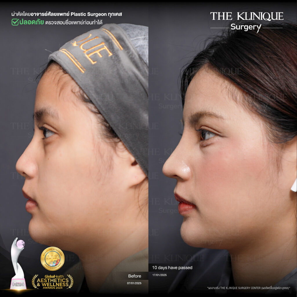 รีวิว เสริมจมูก Semi Open