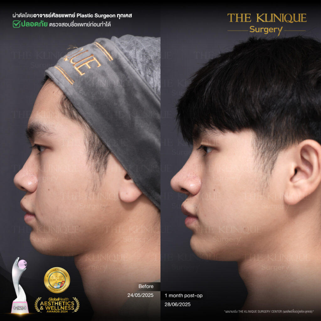 รีวิว เสริมจมูก Semi Open