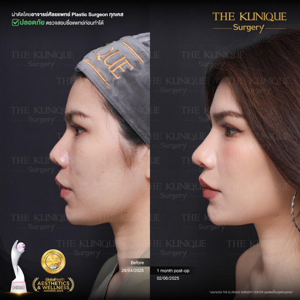 รีวิว เสริมจมูก Semi Open