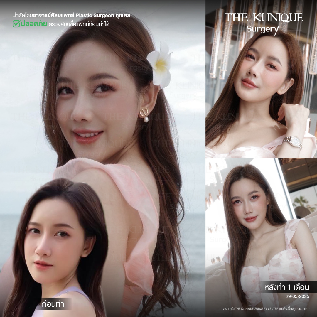 เสริมจมูก Semi Open ปลายมน
