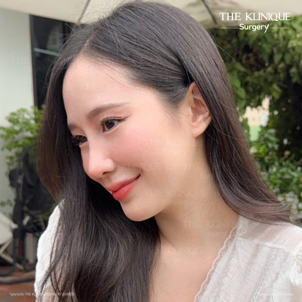 เสริมจมูก Semi Open ปลายมน