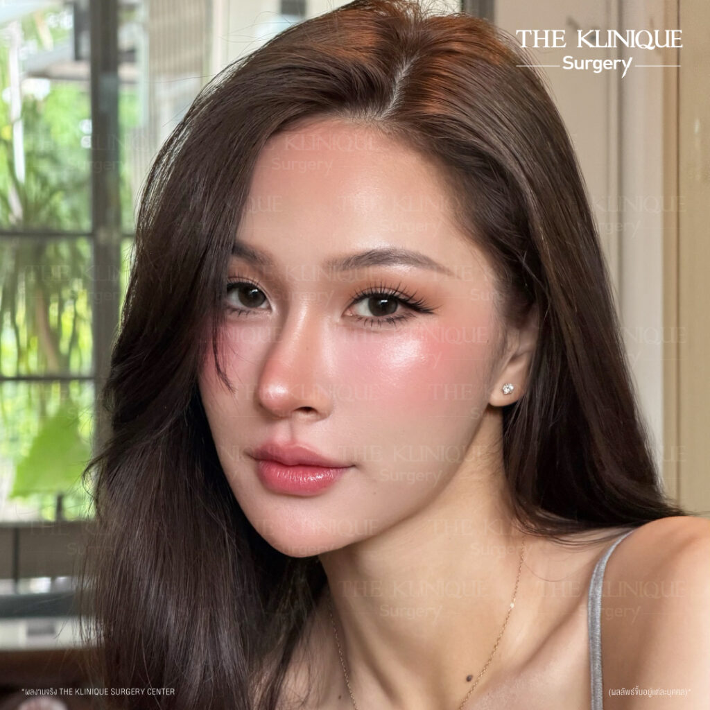 เสริมจมูก Semi Open ปลายมน