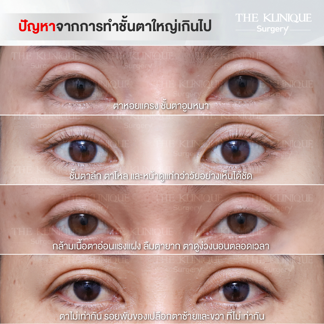 ทำตาสองชั้นธรรมชาติ