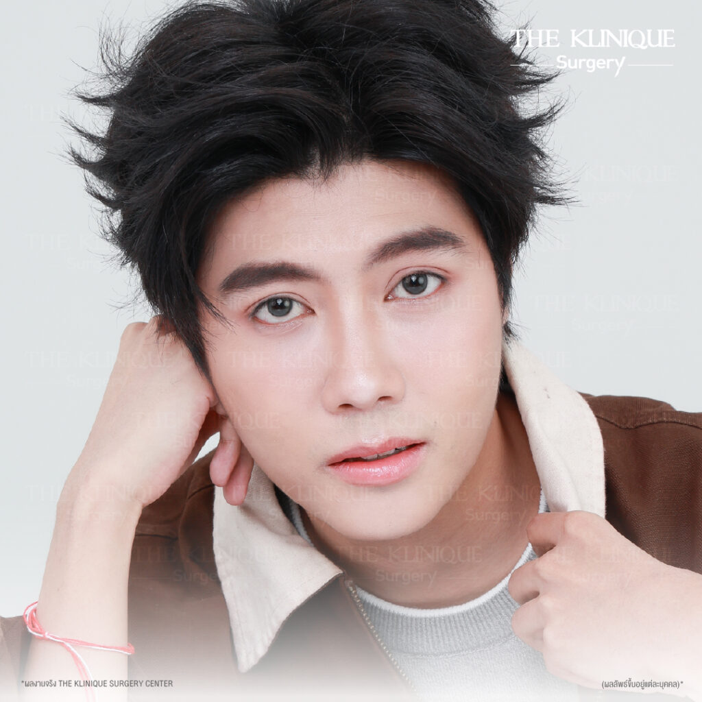 รีวิวทำตาสองชั้นธรรมชาติ