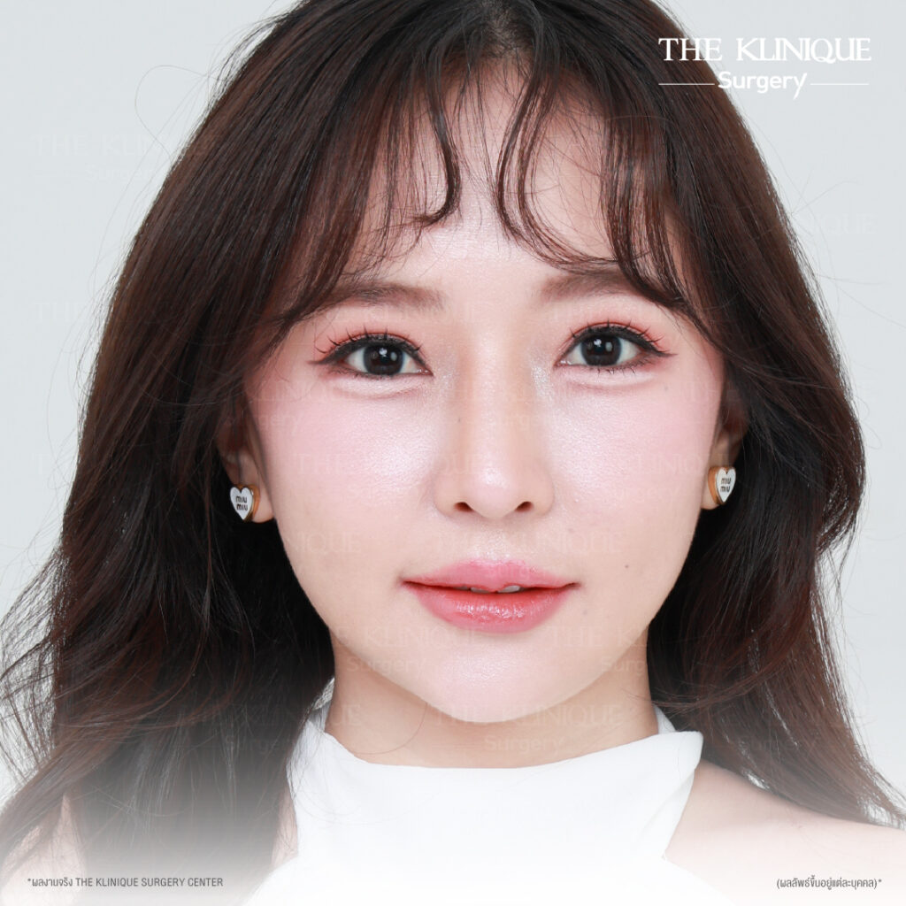 รีวิวทำตาสองชั้นธรรมชาติ