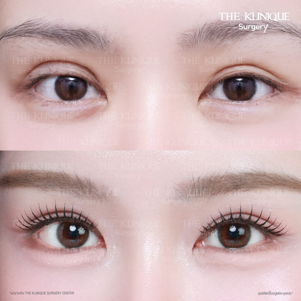 รีวิวทำตาสองชั้นธรรมชาติ