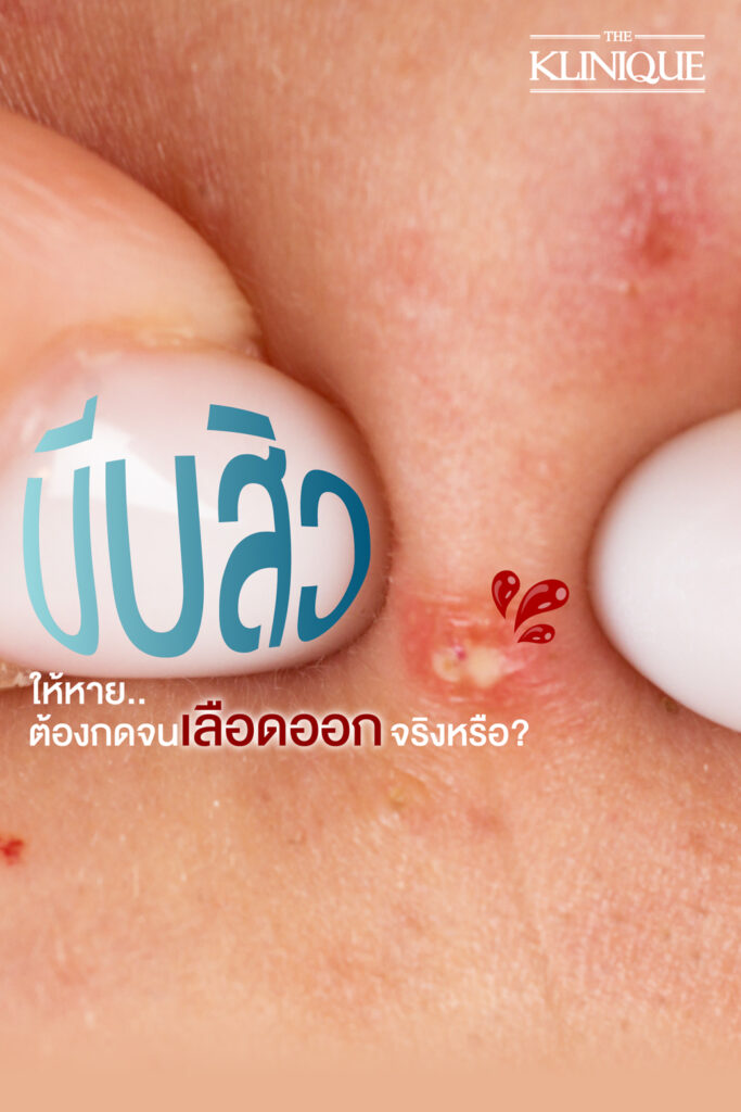 รักษาสิว