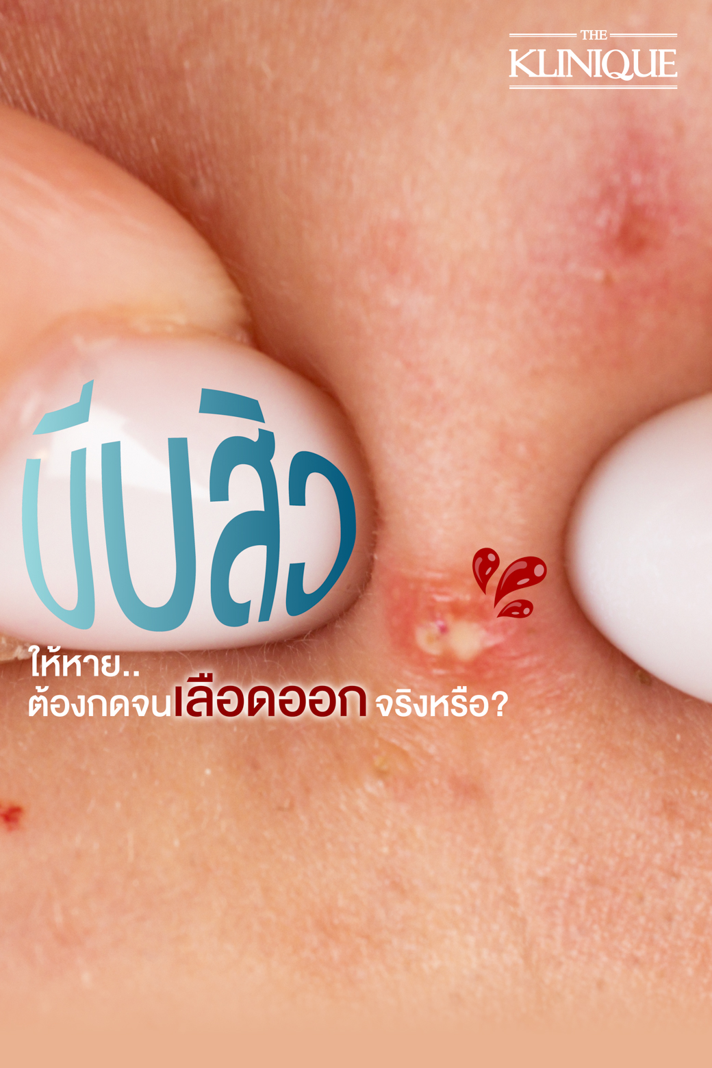 รักษาสิว