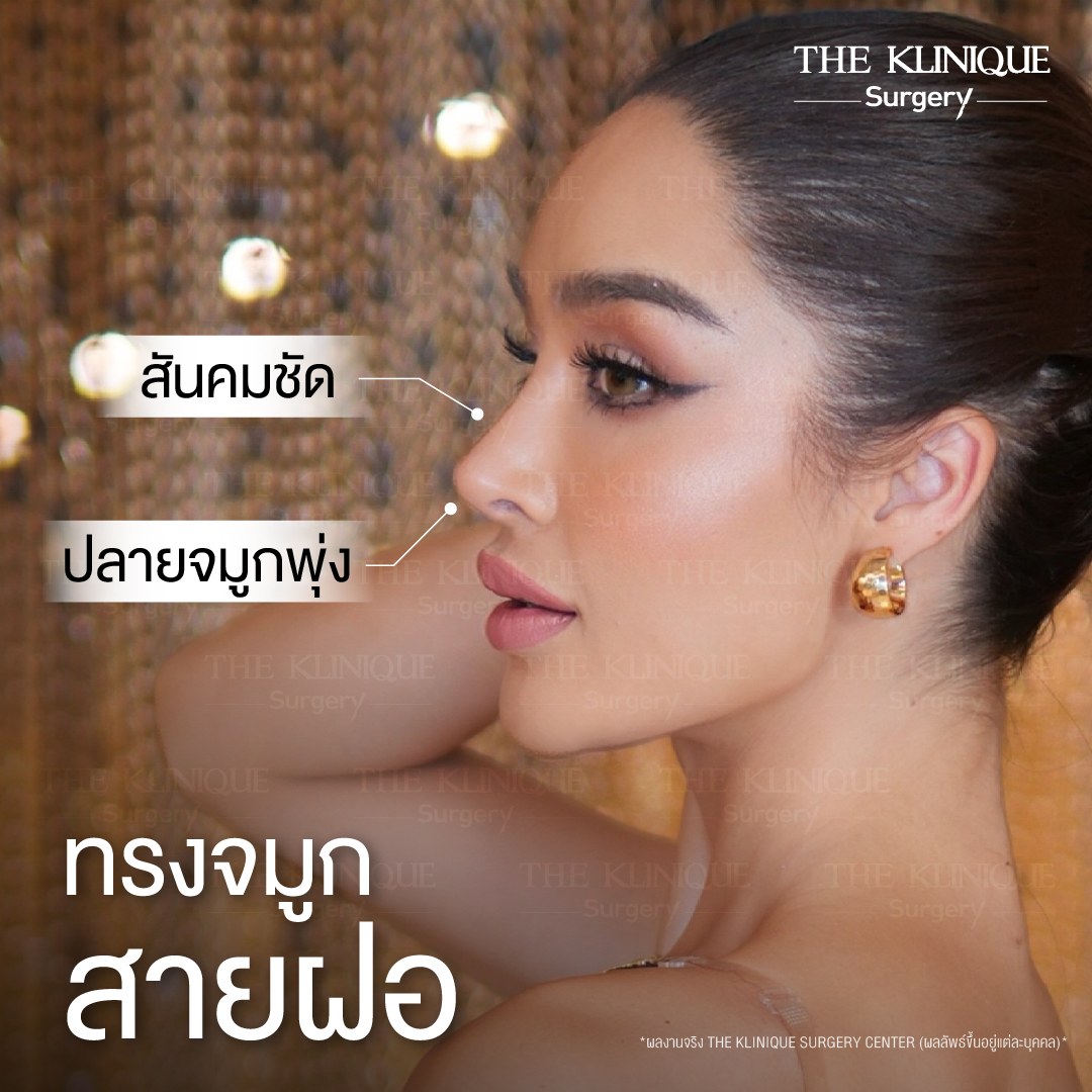 รีวิวเสริมจมูกโอเพ่น ทรงพุ่งสายฝอ เทคนิค Open Reconstruction แก้ไขโครงสร้างด้วยกระดูกอ่อนซี่โครง โดยคุณหมอฮง