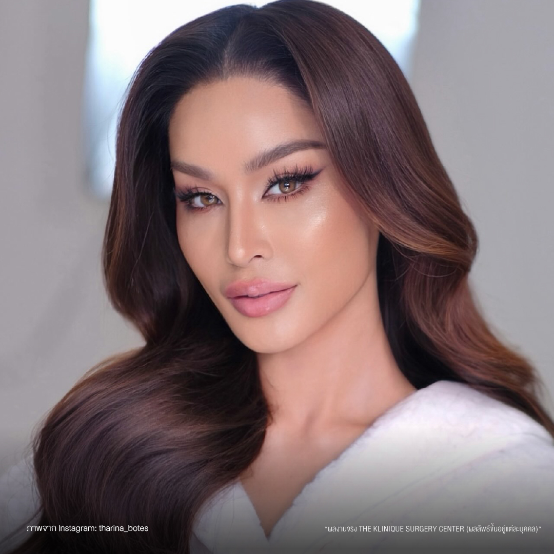 รีวิวเสริมจมูกโอเพ่น ทรงพุ่งสายฝอ เทคนิค Open Reconstruction แก้ไขโครงสร้างด้วยกระดูกอ่อนซี่โครง โดยคุณหมอฮง