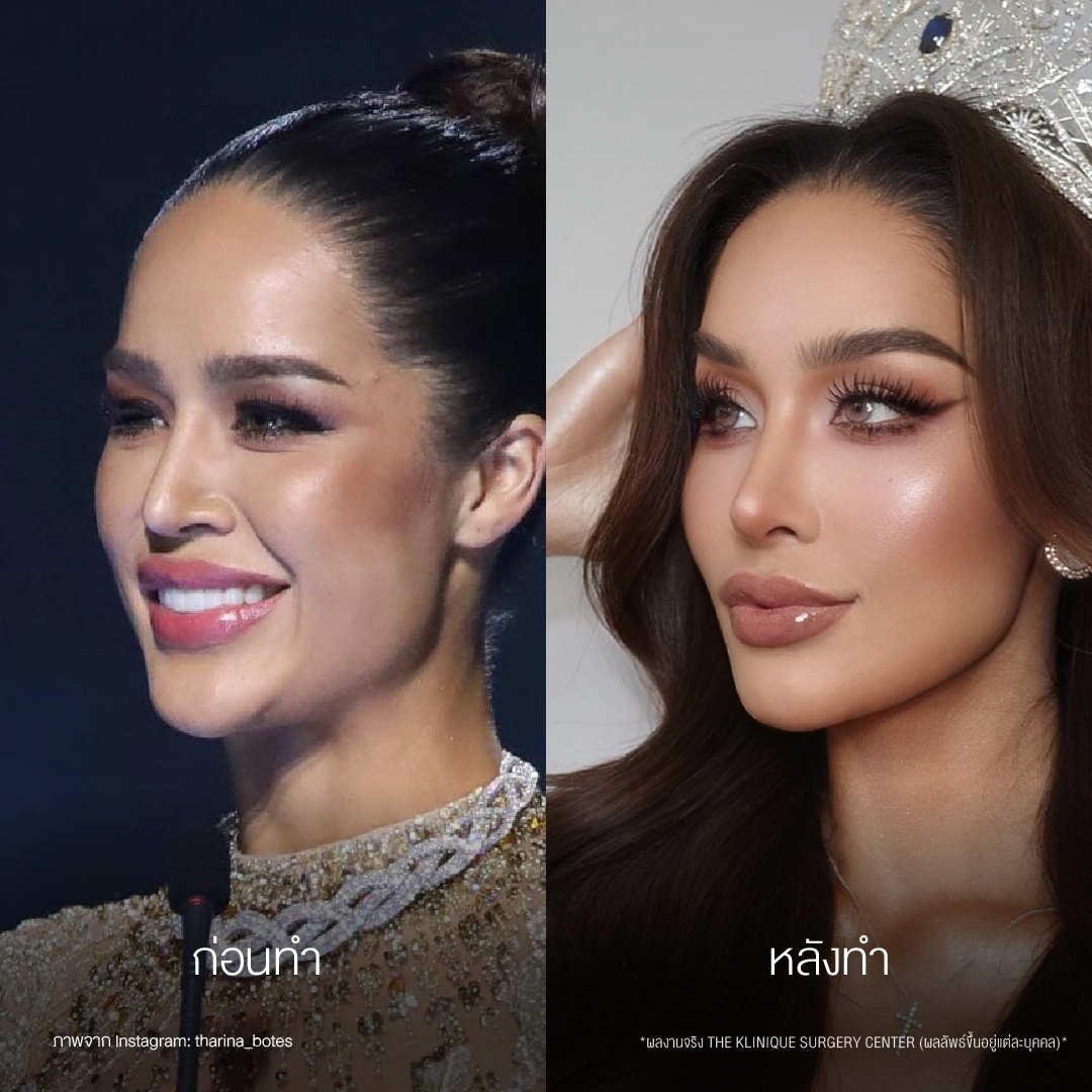 รีวิวเสริมจมูกโอเพ่น ทรงพุ่งสายฝอ เทคนิค Open Reconstruction แก้ไขโครงสร้างด้วยกระดูกอ่อนซี่โครง โดยคุณหมอฮง