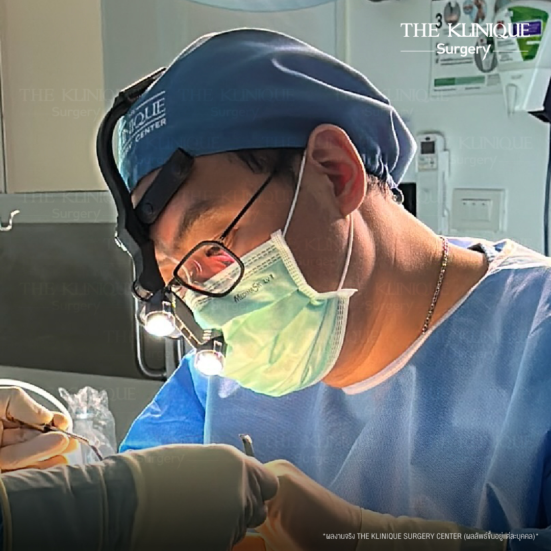 รีวิวเสริมจมูกโอเพ่น ทรงพุ่งสายฝอ เทคนิค Open Reconstruction แก้ไขโครงสร้างด้วยกระดูกอ่อนซี่โครง โดยคุณหมอฮง