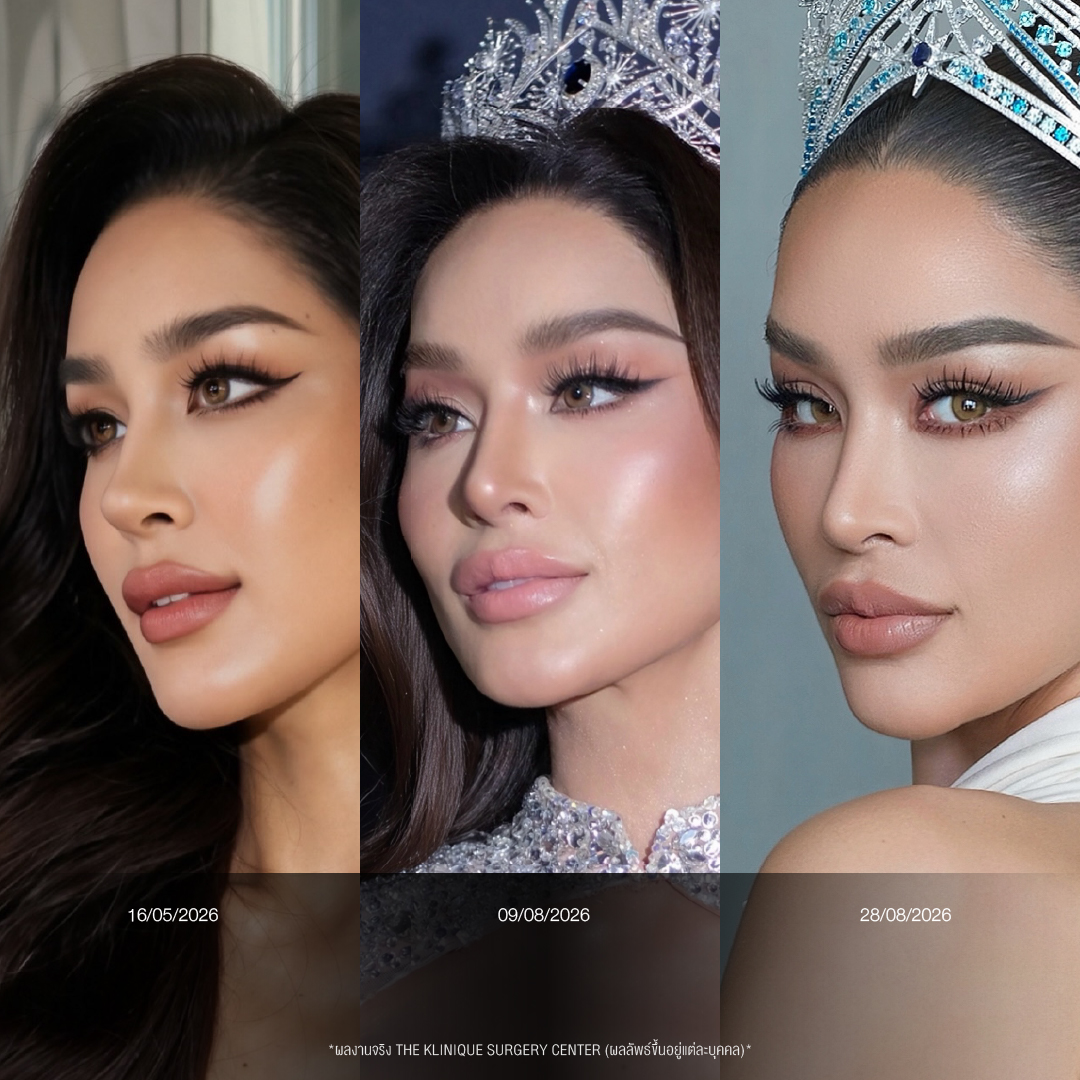 รีวิวเสริมจมูกโอเพ่น ทรงพุ่งสายฝอ เทคนิค Open Reconstruction แก้ไขโครงสร้างด้วยกระดูกอ่อนซี่โครง โดยคุณหมอฮง