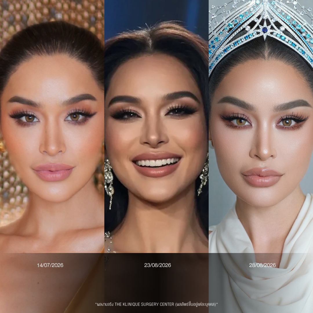 รีวิวเสริมจมูกโอเพ่น ทรงพุ่งสายฝอ เทคนิค Open Reconstruction แก้ไขโครงสร้างด้วยกระดูกอ่อนซี่โครง โดยคุณหมอฮง