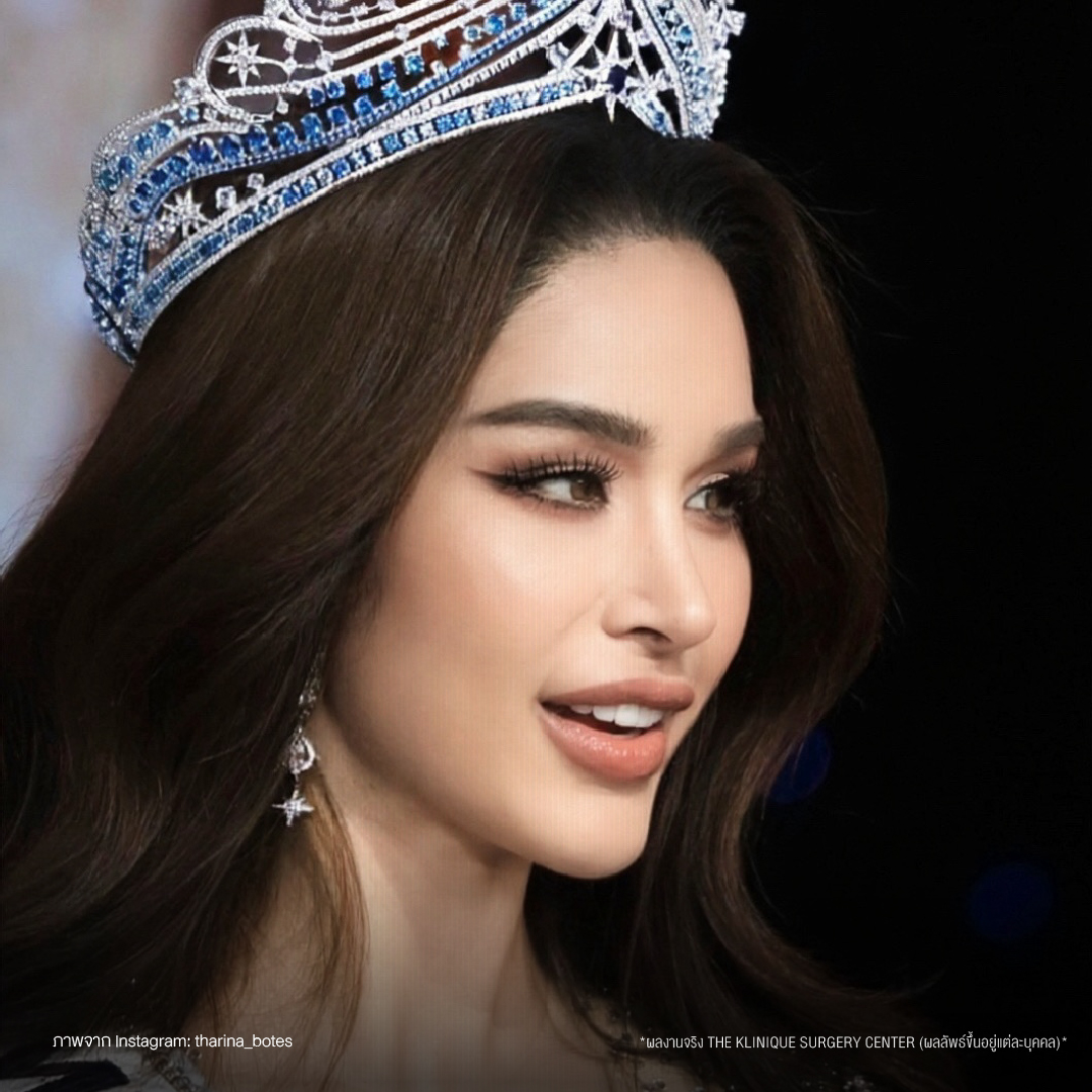 รีวิวเสริมจมูกโอเพ่น ทรงพุ่งสายฝอ เทคนิค Open Reconstruction แก้ไขโครงสร้างด้วยกระดูกอ่อนซี่โครง โดยคุณหมอฮง