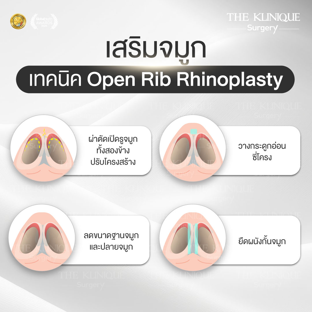 รีวิวเสริมจมูกโอเพ่น ทรงพุ่งสายฝอ เทคนิค Open Reconstruction แก้ไขโครงสร้างด้วยกระดูกอ่อนซี่โครง โดยคุณหมอฮง