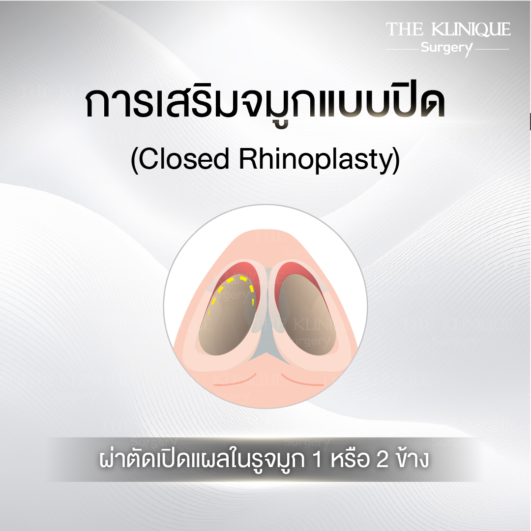 เสริมจมูกแบบปิด (Closed)