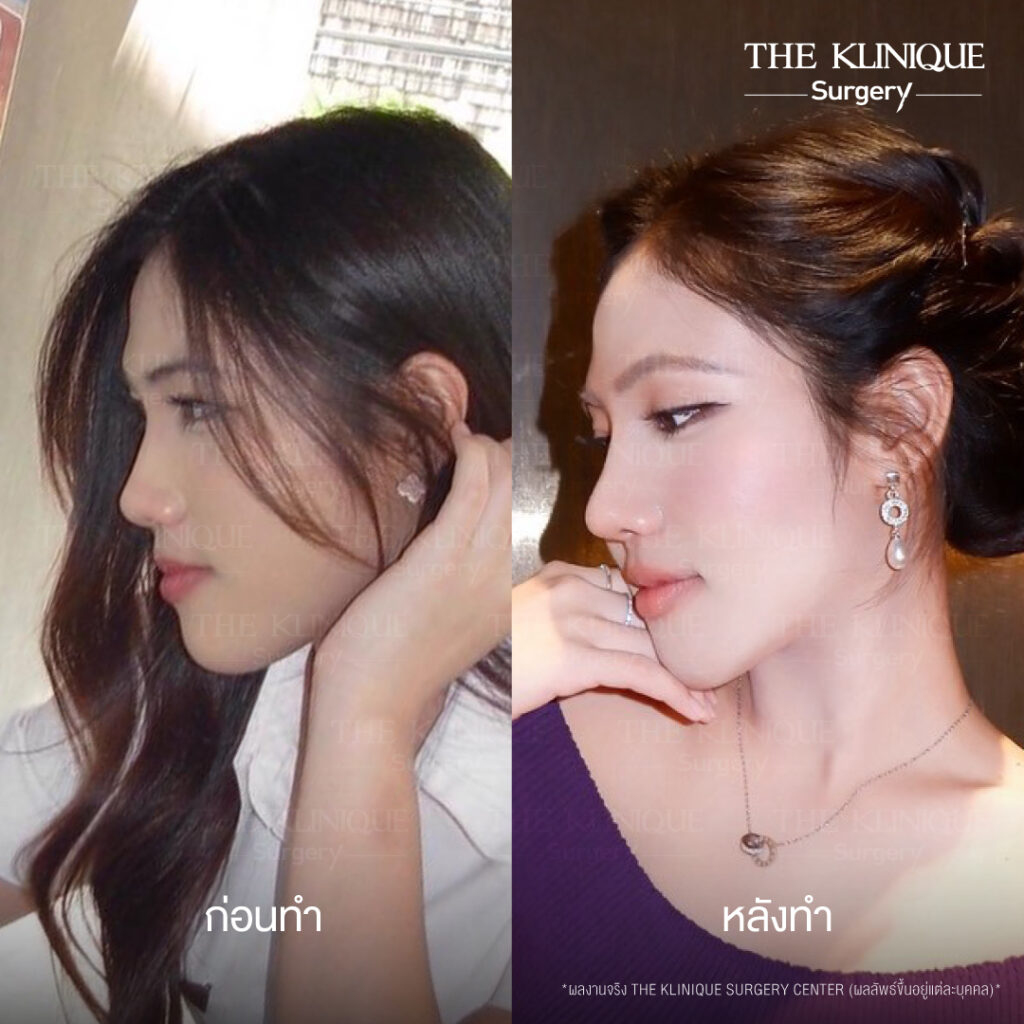 รีวิวเสริมจมูกแบบปิด (Closed)