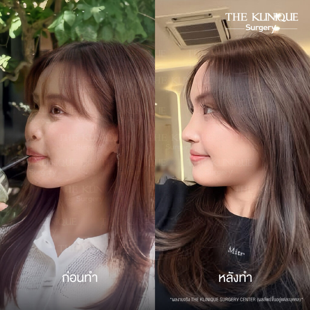 รีวิวเสริมจมูกแบบปิด (Closed)