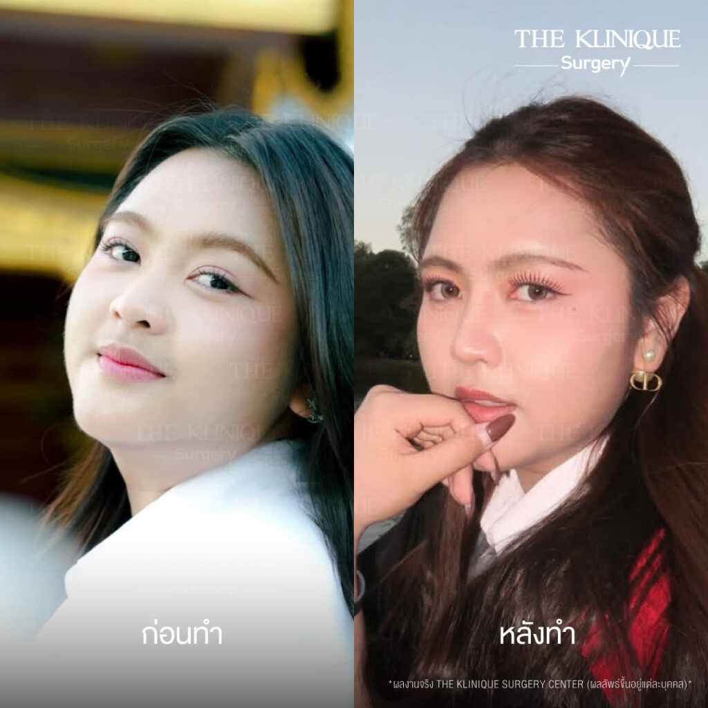 รีวิวเสริมจมูกแบบปิด (Closed)