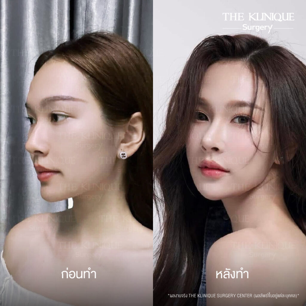 รีวิวเสริมจมูกแบบปิด (Closed)