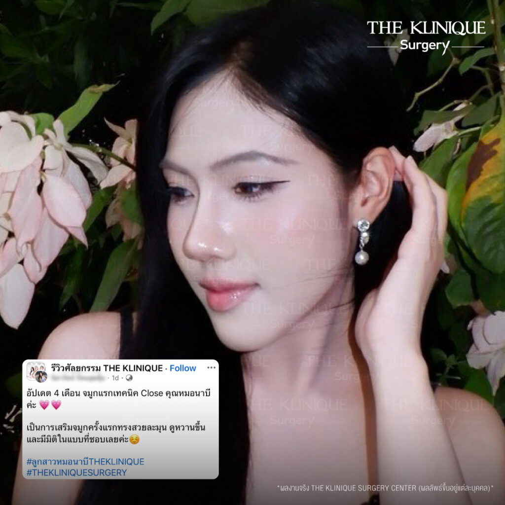 รีวิวเสริมจมูกแบบปิด (Closed)