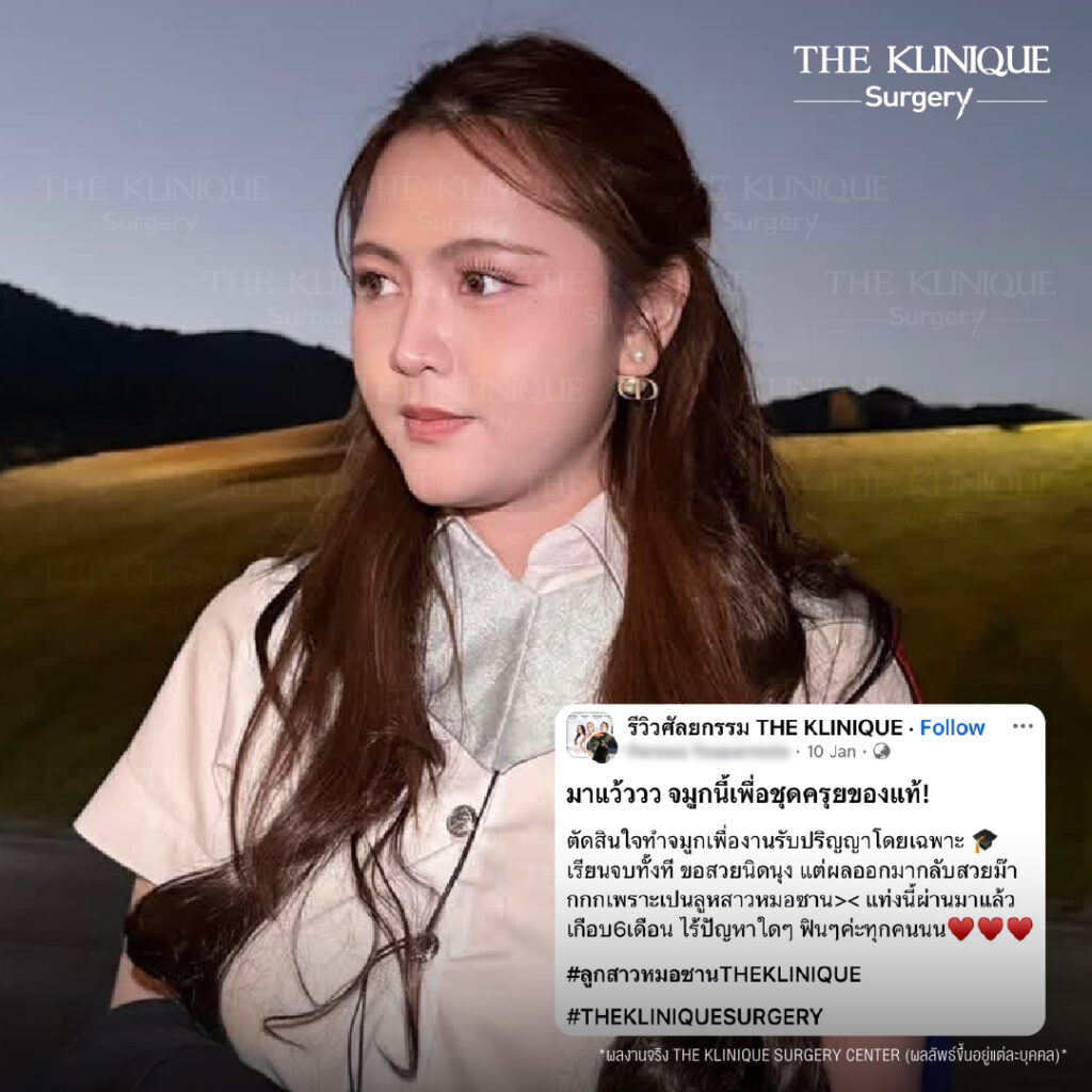 รีวิวเสริมจมูกแบบปิด (Closed)