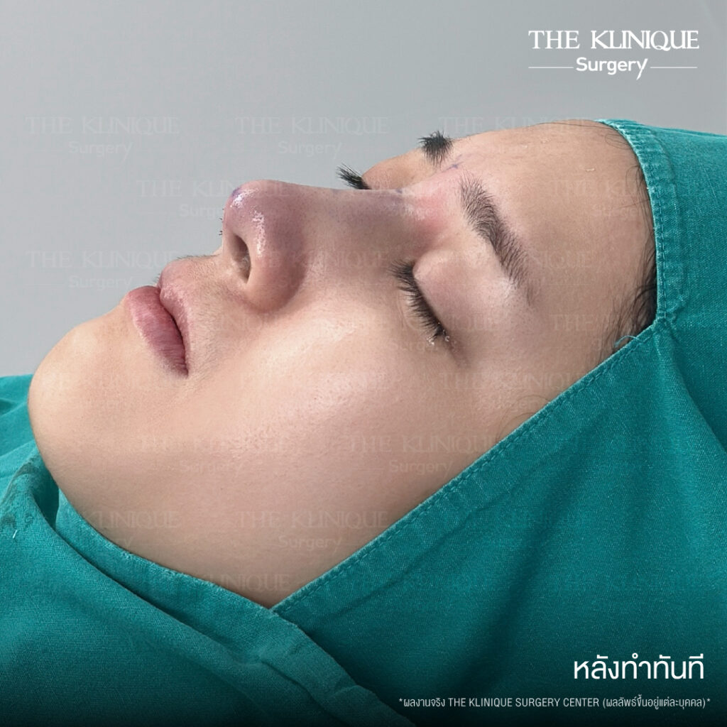 หลังทำทันที รีวิวเสริมจมูกแบบปิด (Closed)