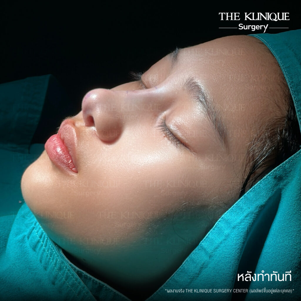 หลังทำทันที รีวิวเสริมจมูกแบบปิด (Closed)