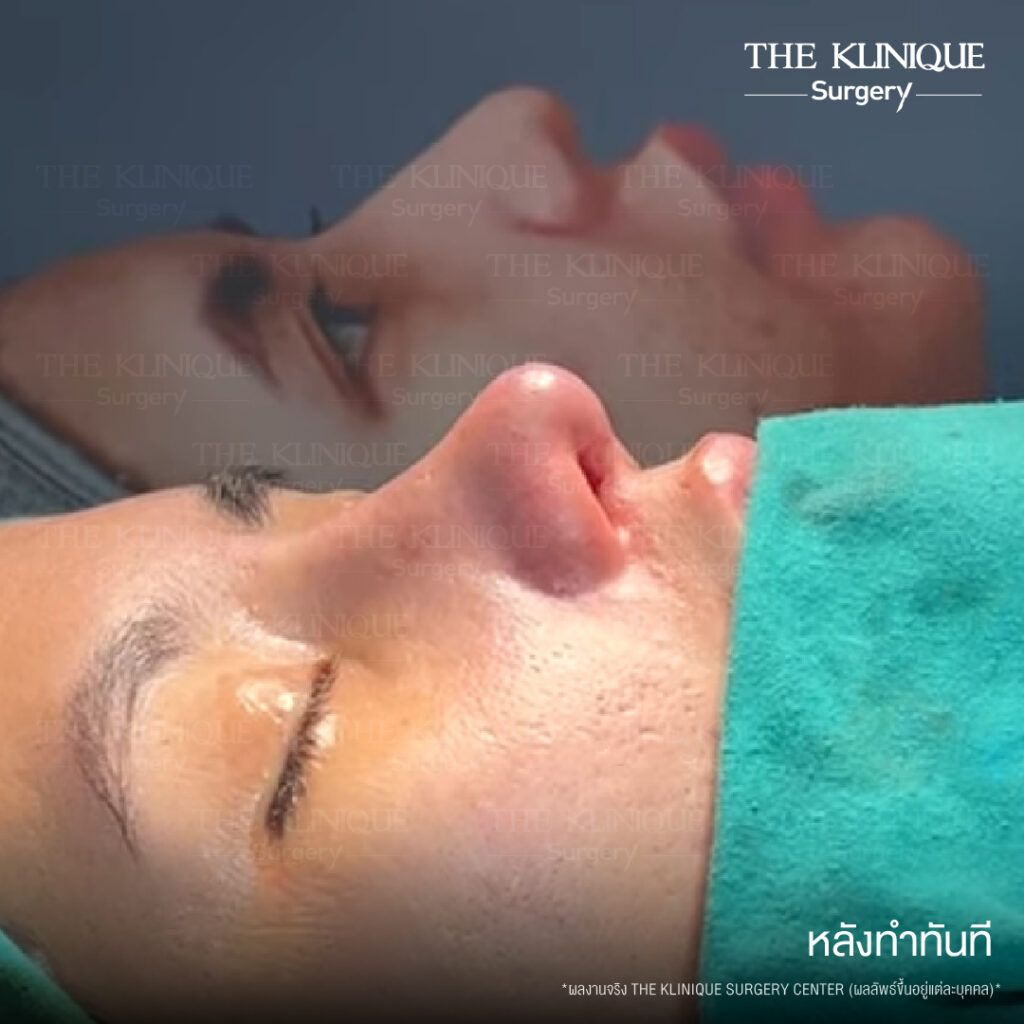 รีวิวเสริมจมูกแบบปิด (Closed)